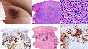 Linfoma B difuso de células grandes asociado al virus de Epstein Barr, No especificado. (A) Imagen clínica que muestra placa indurada infiltrada eritemato-violácea en región superior de muslo derecho en paciente anciana. (B) Con un pequeño aumento se observa infiltrado dérmico en porción superficial y profunda, de patrón nodular (HE, 2X). (C) Con mayor aumento, el infiltrado es heterogéneo con presencia de células grandes de morfología atipica y habito sternbergoide. (HE, 20X). Estas células son (D) positivas para CD30 (2X), (E) EBER (2X) y (F) CD20 (2X).