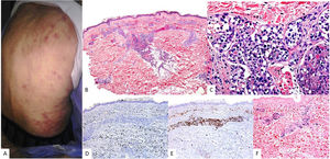 Linfoma de células T/NK cutáneo intravascular. (A) En la imagen clínica se muestran múltiples máculas y placas equimóticas distribuidas en tronco, algunas con distribución lineal o agrupada. (B) (HE, 2X): con un pequeño aumento se observa un infiltrado dérmico con afectación de vasos del plexo superficial y profundo. A mayor aumento (C,10X) este infiltrado se sitúa dentro de los vasos. Se halla constituido por elementos de talla grande atípicos, con marcado hipercromatismo nuclear. Estas células son negativas para CD20 (D, 4X); por el contrario, son positivas para CD3 (E, 4X) y EBER (F, 4X).