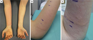 A) Eritema en el antebrazo estimulado de un participante. B) Edema y eritema lineal que afecta la piel del antebrazo expuesta al estímulo vibratorio máximo en el área en contacto con el borde del plato del vórtice. C) Edema lineal y urticaria afectando a otro participante.