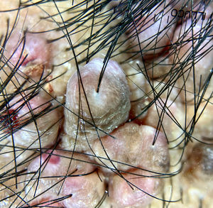 Tricoscopia con pelos en penacho centrados en pápulas de aspecto fibrótico de conformación arracimada.