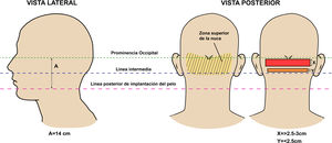 Vista lateral y posterior que indica las referencias anatómicas del área nucal (línea superior demarcada por la protuberancia occipital e inferior por la de implantación posterior del cabello), que delimitan las áreas de tratamiento. Figura adaptada de Umar et al.28.