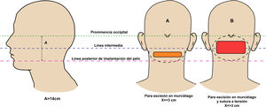 Vista lateral y posterior de la cabeza, que muestra los puntos de referencia para la escisión en murciélago sola (a) y con sutura a tensión. Adaptada de Umar et al.30.