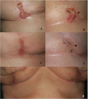 Lesiones inframamarias de lichen sclerosus en la paciente n.° 1 antes del tratamiento (A, derecha; B, izquierda), antes de la 2.a sesión de láser (C, derecha; D, izquierda) y durante el seguimiento transcurrido un año (E).