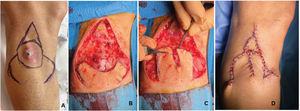 (A) Design of the bishop flap in a patient with squamous cell carcinoma on the leg. (B) Excision of the lesion along with the incision of the flaps. (C) Lateral displacement of the 2 axe-shaped rotation flaps. (D) The island flap is initially moved, and the remaining defect is closed with the 2 lateral axe-shaped flaps.