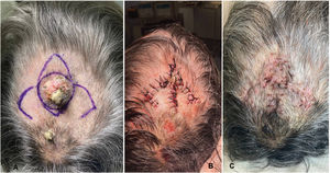 (A) Design of the bishop flap in a patient with squamous cell carcinoma of the scalp. (B) Downward displacement of the subcutaneous pedicle island flap and lateral displacement of the 2 axe-shaped rotation flaps to achieve closure of the surgical defect. (C) Suture removal after 12 days.