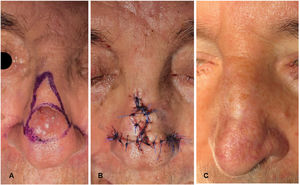 (A) Design of the bishop flap in a patient with basal cell carcinoma on the nasal dorsum. (B) Final suturing after mobilization of the flaps and trimming of the lower angles of the island flap to make sure they fit and facilitate a perfect closure. (C) Final result 3 months after surgery.