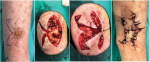 (A) Design of the sigma flap in a patient with squamous cell carcinoma on the leg. (B) Fusiform-shaped excision of the lesion and incision of the 2 axe-shaped flaps. (C) Rotation of both axe-shaped flaps. (D) Final suturing.