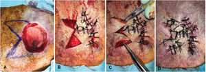 (A) Design of the sigma flap in a circular defect on the scalp. (B) Rotation of the 2 axe-shaped flaps and suturing on the contralateral side and transversely in the center of the defect. (C) Split of the remaining lateral skin into 2 parts to fit into the secondary defect. (D) Final suturing.