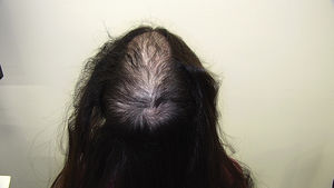 Trichotillomania-related extensive diffuse alopecia in the interparietal region and vertex in a young woman.