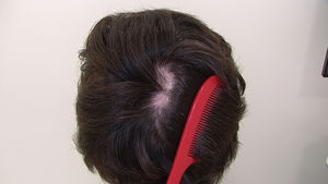 Oval-shaped alopecia patches in the vertex region. Differential diagnosis includes alopecia areata and dissecting cellulitis.