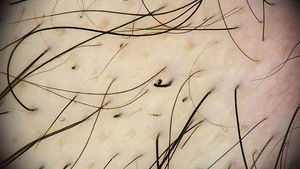 Trichoscopy of a trichotillomania-related alopecia patch. Black dots are visible, and a coiled hair generated by traction on the hair shaft (center of the image).