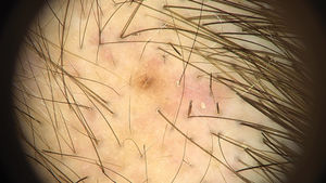 Trichoscopy of an alopecia patch with trichotillomania showing exclamation mark hairs and trichoptilosis (broom hairs).