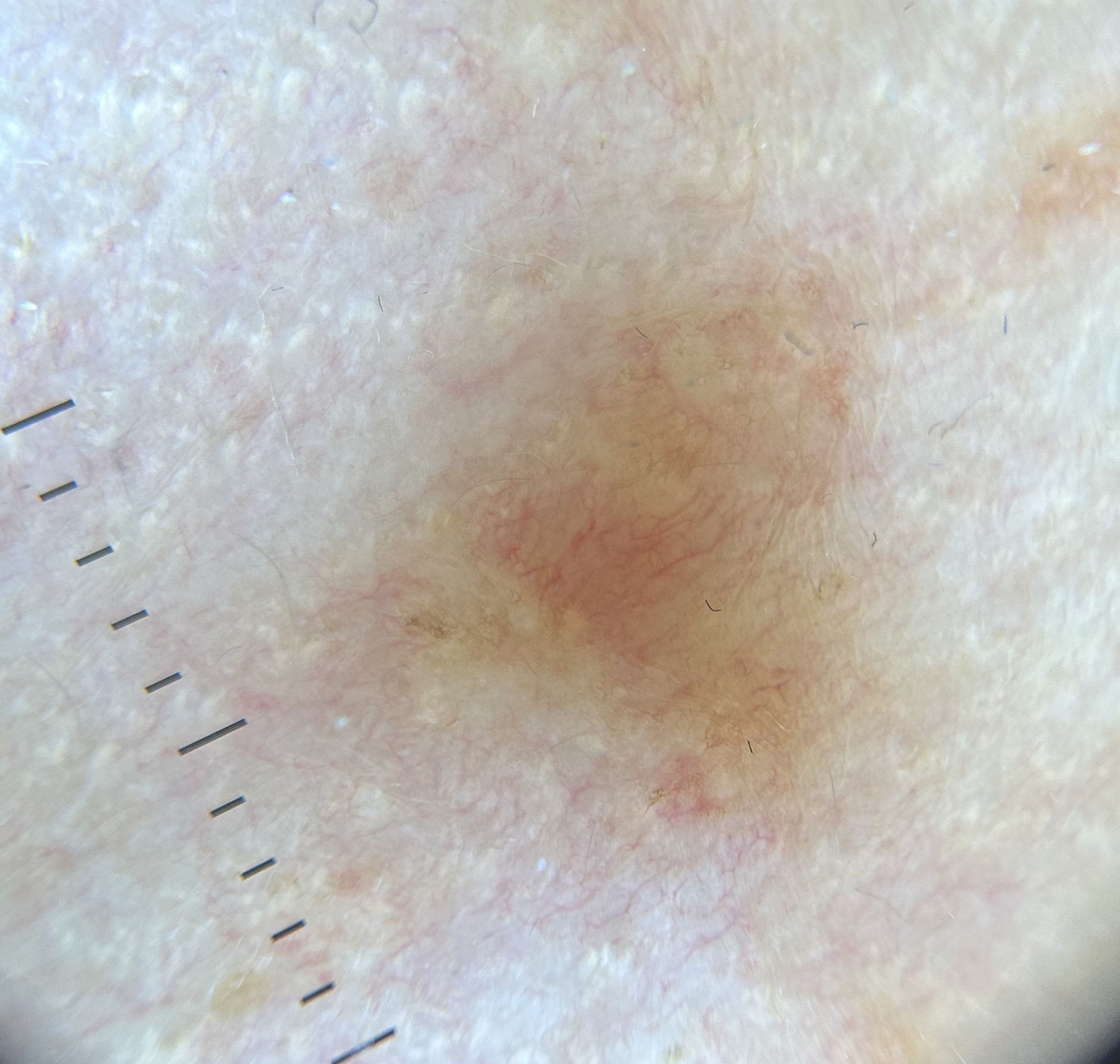 Typical Reticulation Line Intertriginous Eruptive Syringoma | Actas Dermo-Sifiliográficas
