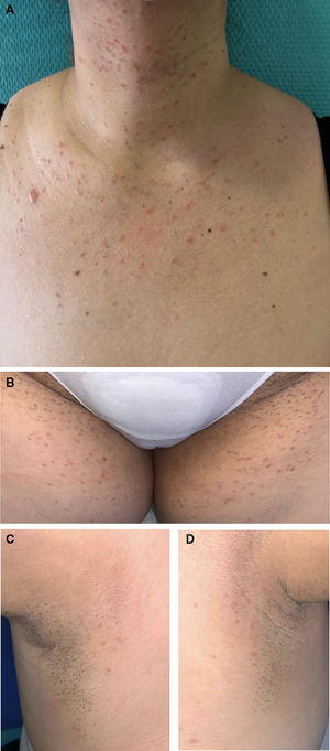 (A–D) Multiple erythematous-yellowish, monomorphic, symmetrical papules on the neck and chest, groin, and axillae.