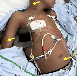 Purpuric nodules, 5mm in diameter, located on the neck, right upper limb, and abdomen (arrows).