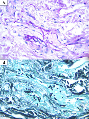 A group of hyaline and septate hyphae located intravascularly, and in the dermis immediately adjacent to the vessel. (A) PAS stain. (B) Grocott stain.