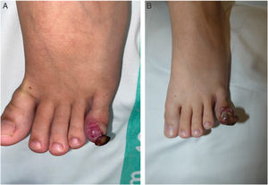 (A) Tumor of the fifth toe with acquired anonychia. (B) Exophytic growth 2 weeks after the first photograph.1