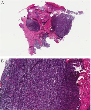 (A) Panoramic view showing a neoplastic infiltrate in a sheet-like pattern (H–E, 40×). (B) Detail of the infiltrate, composed of small round cells with hyperchromatic nuclei (H–E, 200×).2