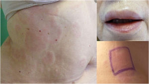 Patient #2. (a) Urticaria affecting the lateral sides of the trunk. (b) Angioedema affecting the upper lip. (c) Positive reaction to the suspended weight test (7kg for 15min) in the form of an edematous plaque that begins 9h after applying the stimulus.