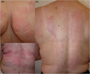 Patient #1. (a–c) Hives and angioedema plaques triggered by sustained pressure (under clothing and after being in bed for prolonged periods).