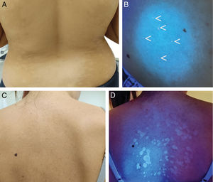 (A) Progressive macular hypomelanosis. (B) Red fluorescence in the follicles of the hypopigmented areas under Wood