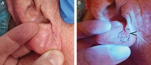 (A) Malignant lentigo on the right ear lobe, difficult to detect and define. (B) With Wood