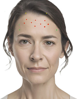 Zigzag infiltration points of the frontal muscle (red), treatment points for lateral frontal wrinkles (green), and frontal elevation points (yellow).