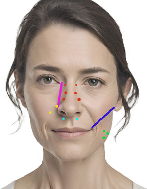 Central nasal area with safety line and infiltration points for nasal wrinkles (red), on the left side, classic treatment points for gingival smile (yellow), alternative points for gingival smile at orbicularis oris muscle level (light blue). Bottom right of the image with points forming a triangle to treat the masseter (green) and safety line (dark blue).