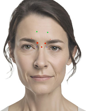 Treatment points for the glabella with the one21 (One21) technique (red and green), 3 points of an alternative technique with only 3 points (large red), infiltration points of the depressor superciliary muscle (blue).