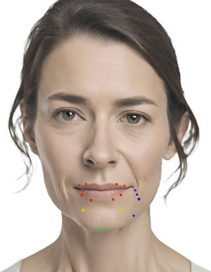 Infiltration point for the orbicularis oris (red) and mentalis muscles (green), infiltration points for the DAO, with the 3 upper-point technique or the classic technique with one upper point next to the commissure and the lower point on the mandibular border (blue), and infiltration points for the DLI (yellow points).