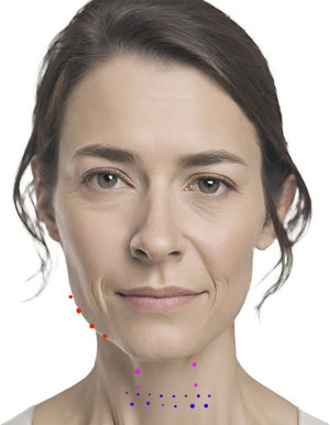 Infiltration points for the mandibular border (red), platysmal bands (pink), and horizontal wrinkles (blue). Note: The image of the model has been generated by artificial intelligence.