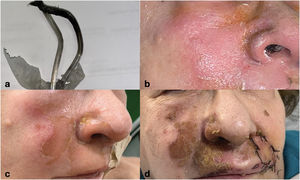 Case of deflagration in facial dermatologic surgery. (a) Carbonized nasal cannula. (b) Immediate condition after burn. (c) Evolution at 7 days. (d) Evolution at 14 days.