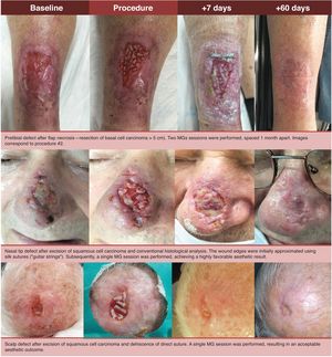 Sequences of the MG technique in 3 patients from our series.