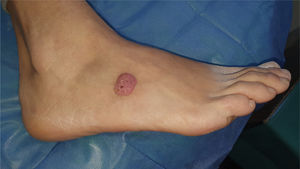 Two-year history exophytic, erythematous tumor lesion with verrucous zones and some hemorrhagic crusts, located on the dorsolateral region of the foot.