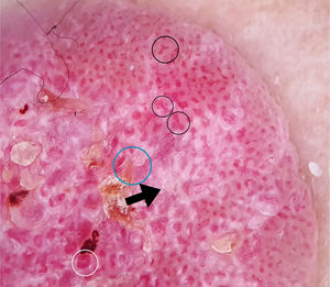 Polarized light dermoscopic images of the lower region of the lesion. Red vascular bed-like areas (white circle), branched vessels with rounded ends (black circles), yellowish structureless areas (blue circle), and intertwined white areas surrounding the vessels (black arrow) are observed.