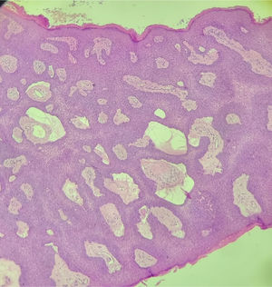 Epidermis with focal hyperkeratosis. Anastomosing cords spreading toward the dermis are visible. H&E stain, ×10.