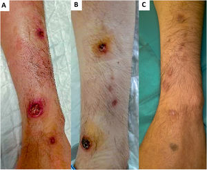 (A) Rounded ulcers with erythematous–violaceous borders. (B) Ulcers covered with black crust. (C) Depressed scars.