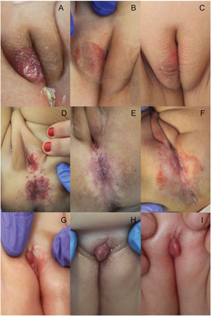 Clinical images of vulvar IHs. Mixed ulcerated IH in a 2-month-old girl (A). Three months into propranolol 3mg/kg/day (B) and at the end of treatment (9 months) (C). Segmental vulvar and perianal IH in a 7-month-old girl (D). Five months into propranolol 3mg/kg/day (E) and at the end of treatment (7 months) (F). Superficial focal IH in the clitoris of a 6-month-old girl (G). At 12 months of age, on timolol 0.5% gel and PDL (H). One month into propranolol with decreased volume and erythematous component (I) – lost to follow-up.