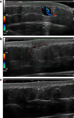 a)Ecografía correspondiente a la lesión número2, que muestra una lesión hipoecoica, de morfología redondeada y bordes bien definidos, siguiendo un patrón nodular. Se aprecia además la presencia de refuerzo posterior e importante vascularización. b)Ecografía correspondiente a la lesión número4. En este caso se aprecia una lesión heteroecoica, polilobulada y con bordes mal definidos, característica del patrón pseudonodular. La vascularización está presente, pero es menos profusa que en el caso anterior. c)Ecografía correspondiente a la lesión número10. Se trata de una lesión isoecoica y mal definida que sigue un patrón difuso.