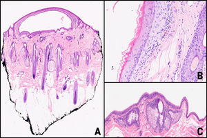 (A) Cavidad quística en dermis superficial. Hematoxilina-eosina ×10 (B) A mayor detalle pared de la cavidad constituida por un epitelio escamoso estratificado, sin capa granulosa y revestido internamente por una cutícula eosinofílica de contorno ondulado. Hematoxilina-eosina ×50. (C) Glándulas sebáceas adyacentes a la cavidad quística. Hematoxilina-eosina ×40.