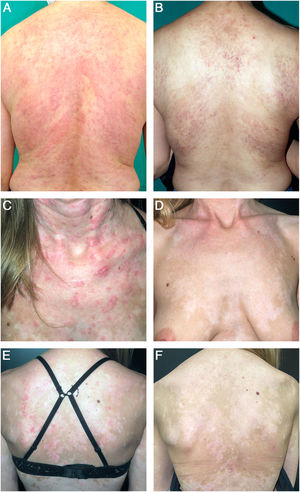 A) Paciente con lesiones de LECS en la espalda. B) A las 16 semanas del inicio del anifrolumab, la paciente no presentaba lesiones activas, únicamente poiquilodermia residual. C-D) Paciente con lesiones de LECS en cuello, tórax y espalda. E-F) Después de 16 semanas de tratamiento con anifrolumab, la paciente mantenía una respuesta completa con hipopigmentación postinflamatoria.