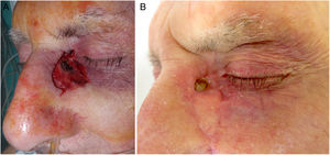 Medial canthus defect (2cm×2cm) after MMS (A). Reconstruction of the lower region (70% of the defect) with an island flap, SIH of the upper region (30% of the defect). Esthetic outcomes after 4 weeks with minimal crusting (B).