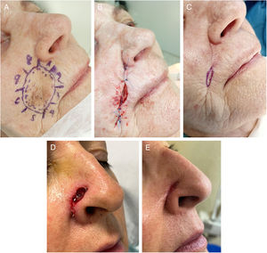SIH on folds. (A–C) Lentigo maligna on the nasolabial fold. (A) Delimitation of lentigo maligna prior to MMS. The nasolabial fold defect (3cm×4cm) was closed using a plication of the upper and lower borders. The central defect (2cm×0.6cm) was left to SIH (B). Complete re-epithelization 4 weeks later (C). (D–E) Defect on the alar groove. Defect (1.5cm×0.5cm) after MMS. (B) Almost complete re-epithelization 3 weeks later. No retraction of the nasal ala seen at the follow-up.