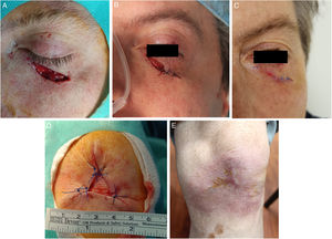 (A–C) Partial closure together with SIH. Lower eyelid defect (2.5mm×0.7mm) after MMS (A). Direct closure on the lower-lateral region, SIH on the upper-medial region (1cm×0.6cm) (B). Almost complete re-epithelization 10 days later. No ectropion was reported (C). (D–E) Defect on the left knee (3.5cm×3cm) of a 94-year-old man. Partial closure of the defect. SIH of the central region (1.5cm×1.5cm) (D). Complete re-epithelization 40 days later. Excellent functional outcomes (E).