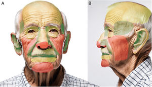 Map of esthetic outcomes of SIH depending on anatomical regiona. Green=good outcomes; Yellow=good outcomes in selected cases; Red=poor outcomes except for superficial and small wounds. aFront- and side-view images were generated using DALL-E by OpenAI and then modified to indicate different colored areas.