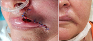 Upper lip defect (1cm×1.5cm) after MMS. Reconstruction of cutaneous lip with a lateral advancement flap. Vermilion defect (1cm×0.5cm) was left to heal by SIHJ (A). Complete re-epithelization after 4 weeks.