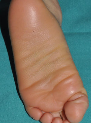 Queratodermia por loricrina. Afectación plantar difusa en un individuo afectado en la que se aprecian pequeñas depresiones de aspecto cribiforme.