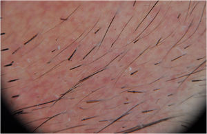 Síndrome de Netherton. Imagen dermatoscópica del pelo de las cejas en la que se aprecian las alteraciones del pelo típicas de la enfermedad (tricorrexis invaginata).