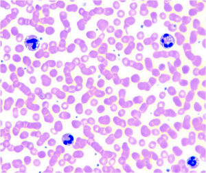 Síndrome de Chanarin Dorfman. Extensión de sangre periférica de un paciente con una variante patogénica en ABHD5 donde se observan gotas lipídicas en el citoplasma de los granulocitos (anomalía de Jordan).