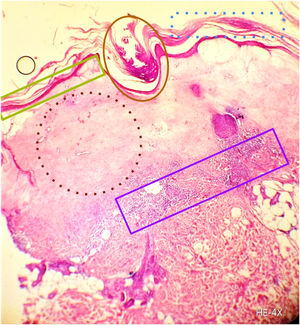 Se observa hiperqueratosis (línea de puntos azul), atrofia epidérmica (cuadrado verde), tapón córneo ortoqueratósico (círculo marrón), edema y homogeneización del colágeno (línea de puntos marrón) e infiltrado linfocitario (cuadrado violeta) (H-E, 4X).